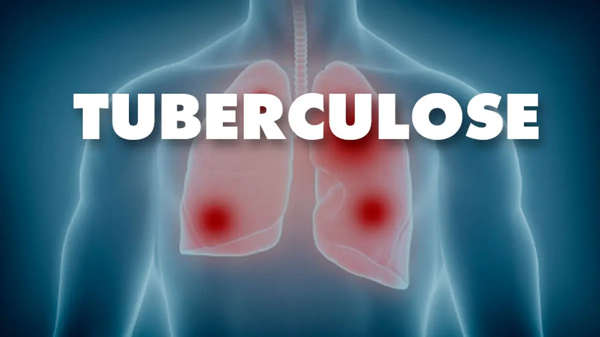 Tuberculose Tuberculose