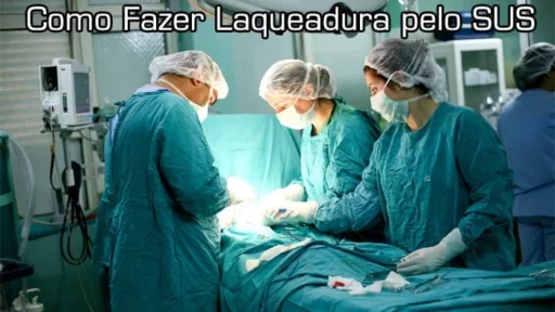 laqueadura Sus