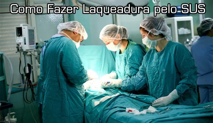 laqueadura Sus laqueadura Sus